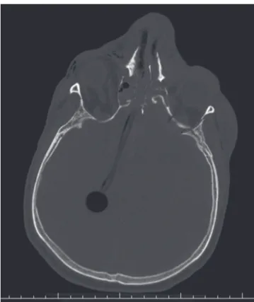 Figure 1.  Axial CT scan of the skull showing through penetration of the ethmoid bone fracture path and intra cerebral Foley catheter.