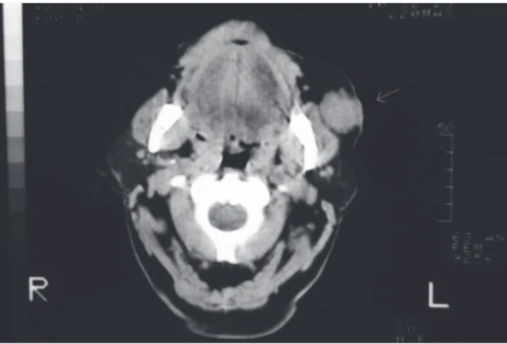 Figure 1. Tumor in the subcutaneous tissue of the left cheek.