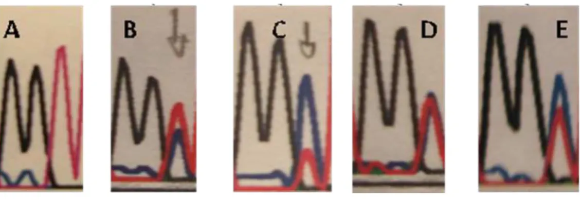 Figura 1: Sequenciamento da família com a mutação A8344G em DNA mitocondrial  (seqüenciamento foi realizado utilizando-se primer reverso) 