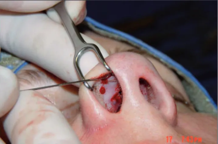 Figure 13. Step 1. Exposure of the domal area with a straight, sharp needle and thread.