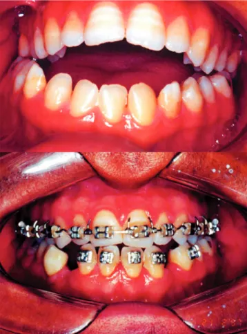 Figure 2. Aspect of pre-and postoperatively with emphasis on dental occlusion.