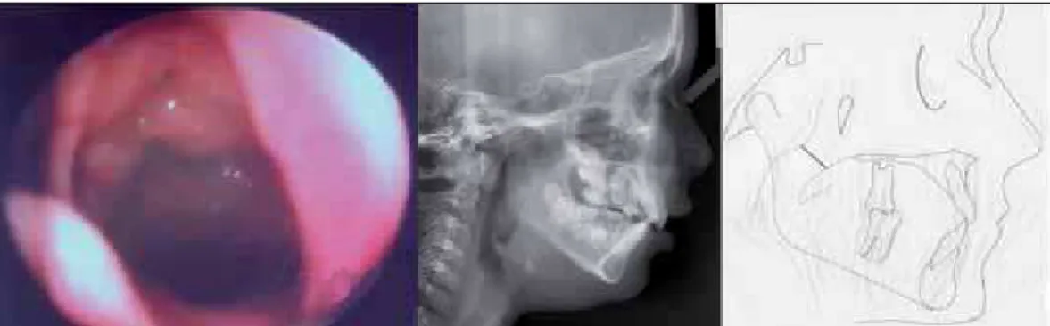 Figure 1. Grade 1 hyperplasia of the pharyngeal tonsils by nasofibropharyngoscopy and cephalometry (cephalometric analysis).