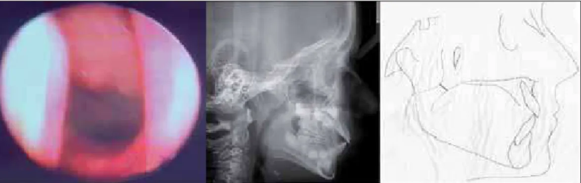 Figure 4. Grade 4 hyperplasia of the pharyngeal tonsils by nasofibropharyngoscopy and cephalometry (cephalometric analysis)