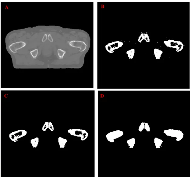 Figure 3.2- Representation of the derivation of the CT bone binary mask. Figure 3.1-A represents the CT image
