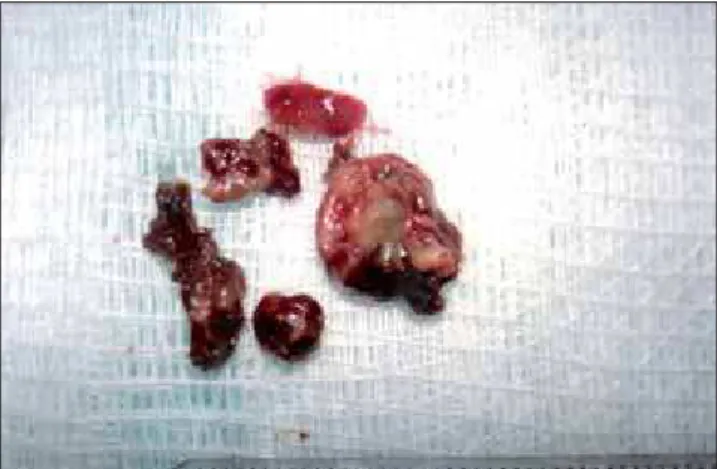 Figure 3. RM of face with hydro-aereal level and presence of hypointense of maxillary sinus left.