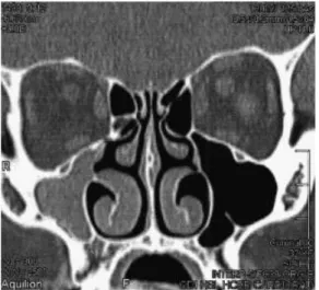 Fig. 2 Axial computed tomography of the nose and paranasal sinuses demonstrates total opaci ﬁ cation and contraction of right maxillary sinus.