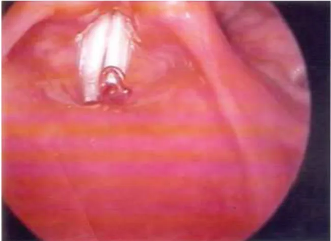 Fig. 1 Video laryngoscopy showing a vermiform organism on the larynx.