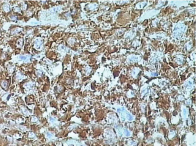 Fig. 4 Histology of rhabdomyoma showing closely packed polygonal cells with deeply eosinophilic vacuolated cytoplasm