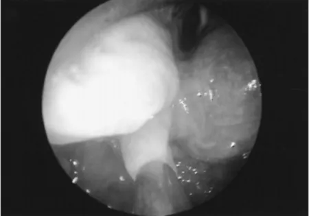 Figure 2. Excess arytenoid mucosa, distended by MPS deposits, that was prolapsing into the  airway with each inspiration(image from Simmons M.A et al, 2005) 4