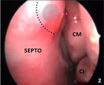 Figure 1. Preoperative coronal section CT scan showing crista galli pneumatization with mucosal thickening.
