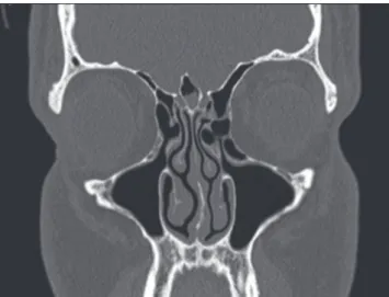Figure 8. Coronal CT section showing mucosal thickening and fluid within the pneumatized crista galli.