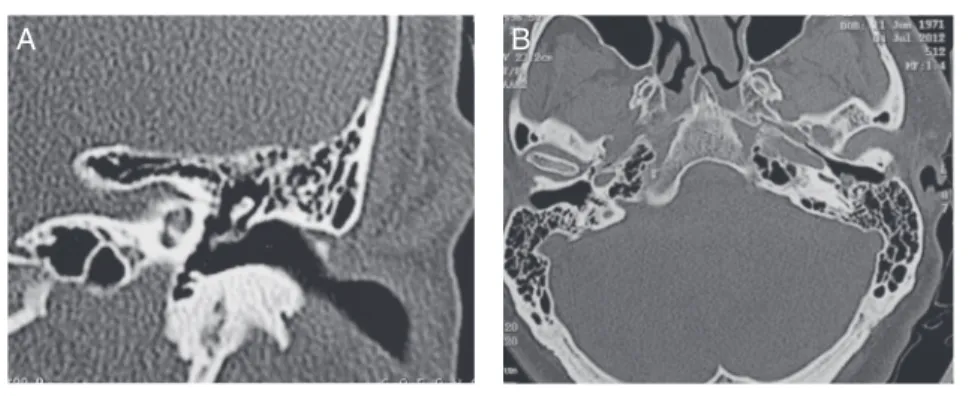 Figure 4. Computed tomography of the temporal bones revealing a small soft tissue density material in the left tympanic cavity