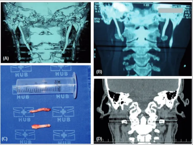 FIGURE 1. (A) Computed tomography (CT) scan of the neck showing elongation and ossification of the styloid processes of the temporal bone