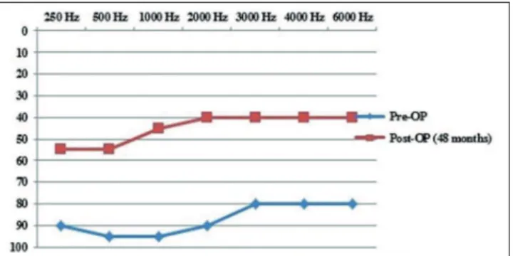 Figure 4.  Intra-operative NRT showing absent evoked potentials on electrodes 1, 22, 11, 6, and 16 at 25-µs pulse width (A) and on electrodes 11 and 15 at 50-µs pulse width (B).