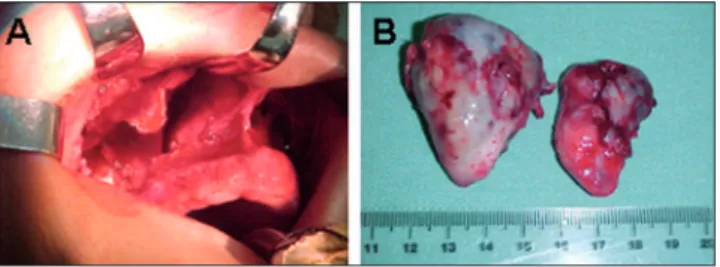 Figure 1. A and B. CT scan of the sinuses in the coronal and axial planes. The right nasal cavity and right maxillary sinus are occupied with material with soft tissue density, and signs of erosion of the maxillary floor are evident.