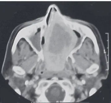 Figure 1. Computed tomography with iodinated contrast in the axial position revealing an expansive and heterogeneous lesion.