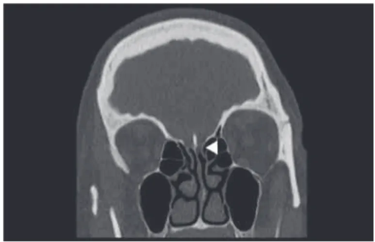 Fig. 3 Bony defect along the left cribriform plate (arrowhead) in a patient with suspected cerebrospinal ﬂ uid leak.