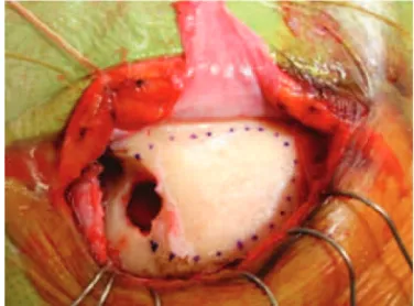 Fig. 7 Intraoperative photograph of a left supraorbital craniotomy demonstrating bur hole and craniotomy placement.