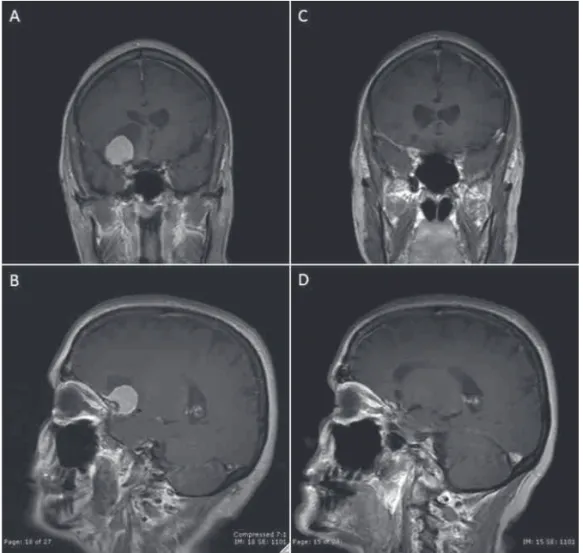 Fig. 8 Case 3. (A, B) Preoperative T1-weighted images with gadolinium demonstrating a homogenously enhancing lesion arising from the right clinoid and medial sphenoid wing with an associated arachnoid cyst