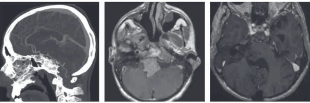Fig. 2 Petroclival midline lytic mass incidentally discovered on computed tomography scan (CT) after a 38-year-old man was involved in a motor vehicle accident (top left)