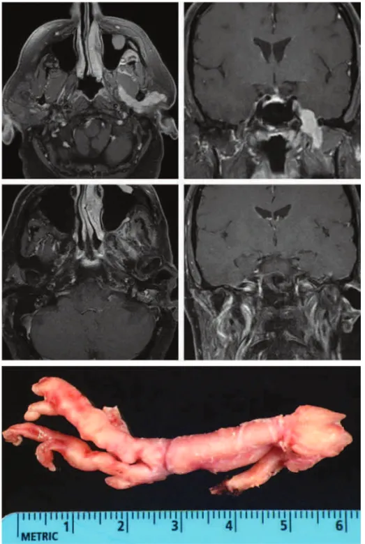 Fig. 6 Magnetic resonance imaging (MRI) and gross pathologic specimen from a patient with a malignant peripheral nerve sheath tumor