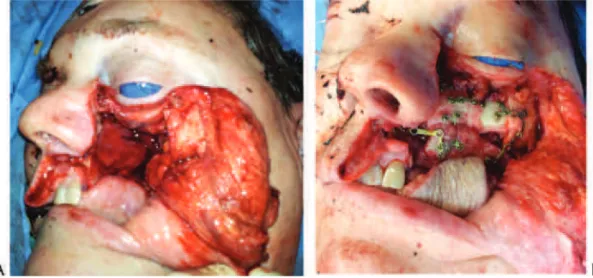 Fig. 7 (A) Maxillectomy and orbital rim defect following the excision of a maxillary sinus sarcoma