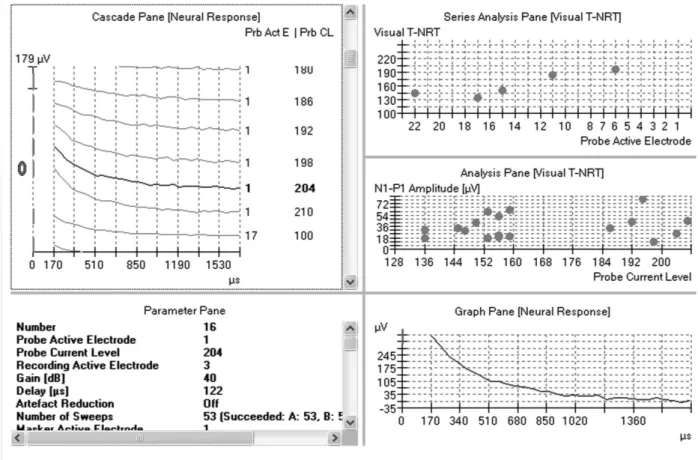 Fig. 2 Patient with hearing loss. Stimulation and recording parameters employed for the measurement of the evoked compound action potential (ECAP) on electrode 1 and stimulation level equal to 204 current units (CU)
