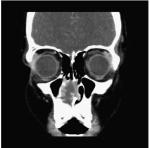 Fig. 1 Preoperative axial computed tomography scan showing the tumor in the right nasal cavity with contrast enhancement.