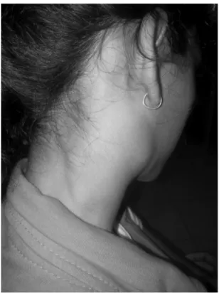 Fig. 2 Cervical lymphadenopathy with scar on left side of neck.