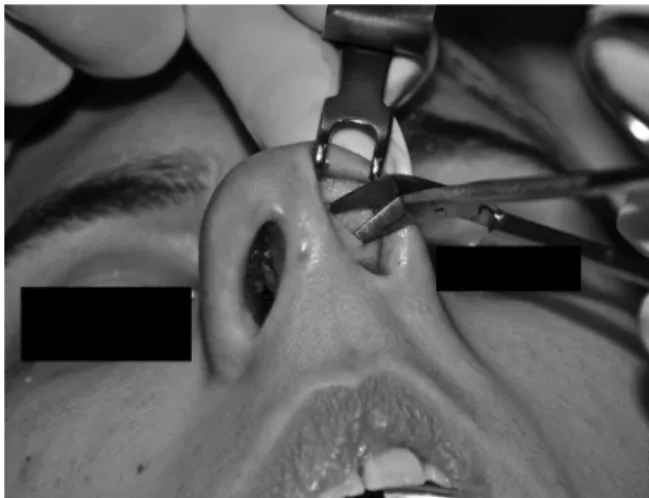 Fig. 9 Perioperative view: dissection of bipedicle ﬂ ap on the medial and lateral vestibular skin using Converse angled scissors.