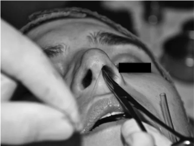 Fig. 16 Perioperative view: hemostatic clamp was used. The knot must be centralized on the interdomal space.