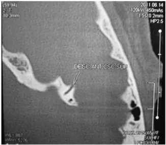 Fig. 3 Left superior semicircular canal dehiscence as seen on coronal temporal bone computed tomography.
