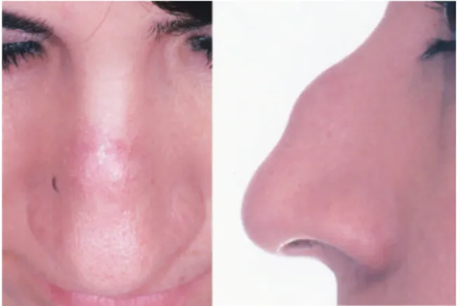 Fig. 4 Intraoperative endoscopic visualization with 30-degree optic demonstrating complete tumor resection of the nasal dorsum.