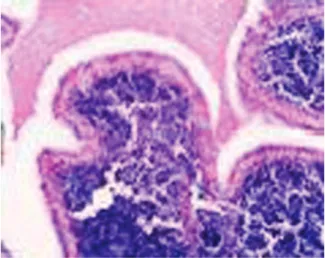Fig. 4 Right parotid tumor. Papillary projections coated by oncocytic cells upon a lymphocytic stroma