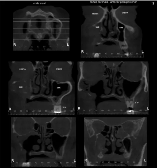 Fig. 2 Computed tomography in axial and coronal sections. Presence of tumor can be observed in the right maxillary sinus.