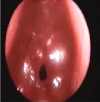 Fig. 3 Previous image and 15 days after balloon dilatation.