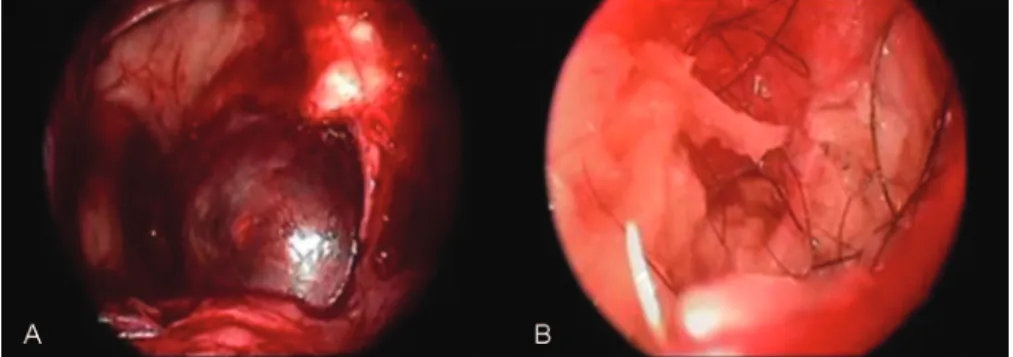 Fig. 3 Intraoperative endoscopic visualization of the dermoid cyst.