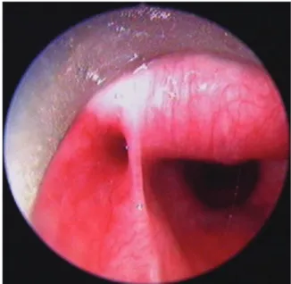 Fig. 1 Pus seen during hypopharyngoscopy at the internal opening in the pyriform sinus.