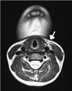 Fig. 4 CT scan of the neck showing the sinus communicating with the left pyriform sinus.