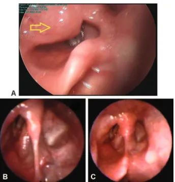 Fig. 2 Endoscopic evaluation of larynx. (A) Preoperative endoscopy shows large supraglottic mass located in the right aryepiglottic fold and covered by apparently normal mucosa, obstructing the view of the vocal cord