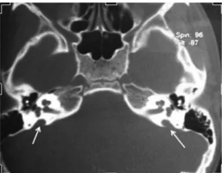 Fig. 2 Computed tomography scan of case 2 showing large vestibular aqueduct.