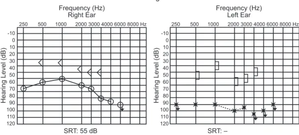 Fig. 1 Audiogram before treatment. Abbreviation: SRT, speech reception threshold.