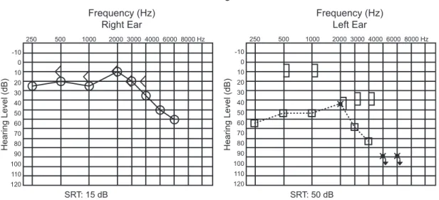 Fig. 4 Audiogram performed after treatment. Abbreviation: SRT, speech reception threshold.