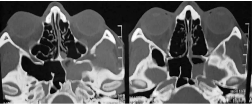Fig. 1 Axial computed tomography shows sphenoid sinus opaci ﬁ cation and greater wing of sphenoid compatible with isolated left sphenoiditis.