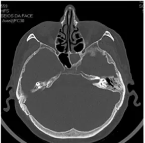 Fig. 3 Preoperative coronal computed tomography shows left sinus opaci ﬁ cation evolving to extradural empyema.
