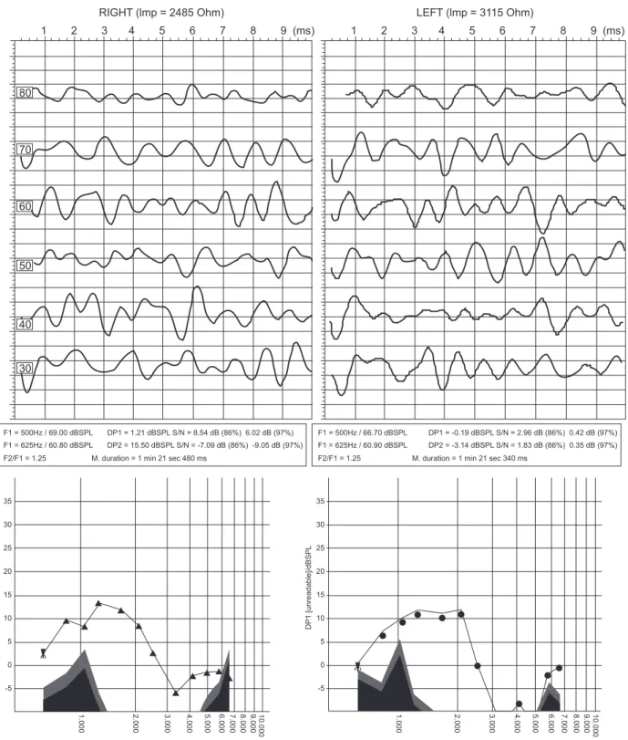 Fig. 1 Left and right ear auditory brain stem response and distortion product otoacoustic emission recording of a case of auditory neuropathy/