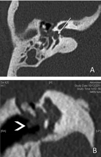 Fig. 3 Second computed tomography scan. The presence of air within the inner ear space (arrowhead) permits the visualization of the tube that penetrates into the vestibule (arrow).