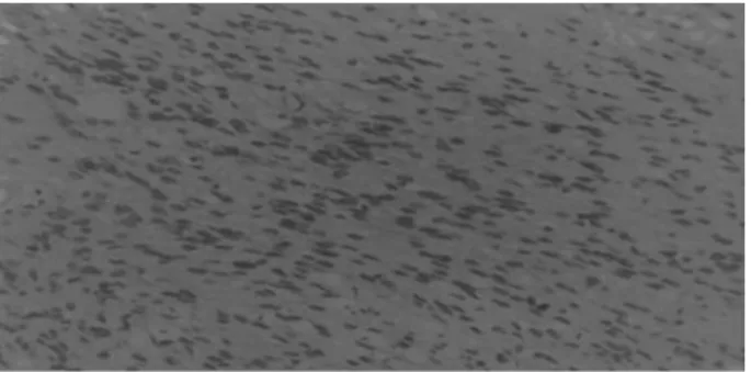 Fig. 1 Coronal magnetic resonance imaging showing extensive mass growing down from cribriform plate.