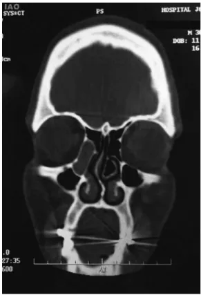 Fig. 2 Computed tomography of the paranasal sinuses, coronal section, in bone window, showing hypodense cystic lesion in the right nasolacrimal duct topography.