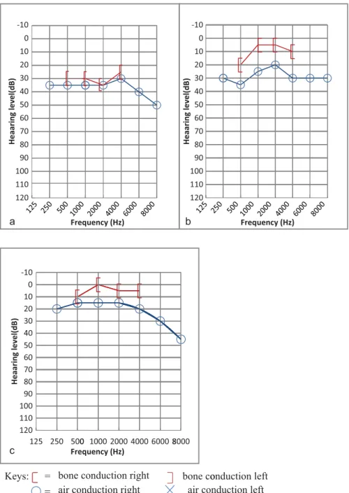 Fig. 1 (a) Right audiogram of a 49-year-old female tinnitus sufferer in the study group with mild sensorineural hearing loss